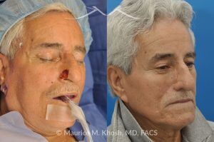 Photo of a patient before and after a procedure. Mohs Surgery and Nasal Reconstruction for Basal Cell Carcinoma - This 69 year old gentleman had Basal Cell Carcinoma of the skin of the right nasal lobule (shown on the left side). The skin cancer was removed via the Mohs technique resulting in near total loss of the right nasal ala (central picture). The nose was reconstructed in a two stage operation utilizing a right nasolabial flap and cartilage graft. The final results are shown on the right side of the picture.