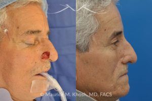 Photo of a patient before and after a procedure. Mohs Surgery and Nasal Reconstruction for Basal Cell Carcinoma - This 69 year old gentleman had Basal Cell Carcinoma of the skin of the right nasal lobule (shown on the left side). The skin cancer was removed via the Mohs technique resulting in near total loss of the right nasal ala (central picture). The nose was reconstructed in a two stage operation utilizing a right nasolabial flap and cartilage graft. The final results are shown on the right side of the picture.