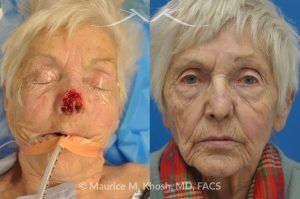Photo of a patient before and after a procedure. Nose Mohs skin cancer repair, utilizing forehead flap and ear cartilage graft - before and after photos.