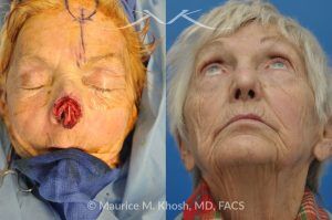 Photo of a patient before and after a procedure. Nose Mohs skin cancer repair, utilizing forehead flap and ear cartilage graft - before and after photos.