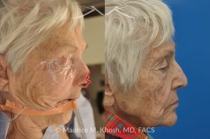 Photo of a patient before and after a procedure. Nose Mohs skin cancer repair, utilizing forehead flap and ear cartilage graft - before and after photos.