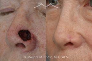 Photo of a patient before and after a procedure. Mohs repair of lower nose - before and after photos.