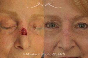Photo of a patient before and after a procedure. Repair of Moh's skin cancer defect of nose - Reconstruction of nose after basal cell cancer excision.