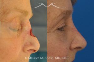 Photo of a patient before and after a procedure. Repair of Moh's skin cancer defect of nose - Reconstruction of nose after basal cell cancer excision.
