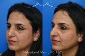 Photo of a patient before and after a procedure. Left Forehead Osteoma removal — No Visible Scar 1 - A large left sided upper forehead osteoma was removed through an invisible incision within the hairline. 