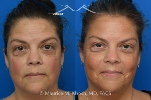 Photo of a patient before and after a procedure. Left Upper Forehead Osteoma Removal Without a Visible Scar 1 - Left upper forehead osteoma was removed through an invisible incision within the hearline. 