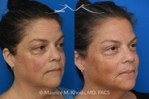 Photo of a patient before and after a procedure. Left Upper Forehead Osteoma Removal Without a Visible Scar 1 - Left upper forehead osteoma was removed through an invisible incision within the hearline. 