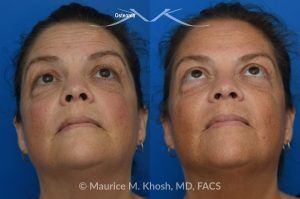 Photo of a patient before and after a procedure. Left Upper Forehead Osteoma Removal Without a Visible Scar 1 - Left upper forehead osteoma was removed through an invisible incision within the hearline. 