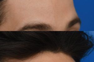 Photo of a patient before and after a procedure. Osteoma Removal Without a Visible Scar 1 - Left mid forehead osteoma was removed through an invisible incision inside the hairline. 