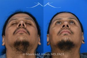 Photo of a patient before and after a procedure. Revision rhinoplasty and repair of nasal vestibular stenosis 1 - This patient previously sustained a nasal fracture that was treated with rhinoplasty. Unfortunately, the surgery did not resolve his breathing obstruction. The nasal bridge had been excessively lowered, creating a “ski-slope” profile, and the cartilaginous dorsum remained deviated to the left. During his revision rhinoplasty, the persistently deviated caudal septum was reconstructed with a strut graft, and the dorsal alignment and height were restored using a right sided spreader graft.  