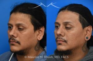 Photo of a patient before and after a procedure. Revision rhinoplasty and repair of nasal vestibular stenosis 1 - This patient previously sustained a nasal fracture that was treated with rhinoplasty. Unfortunately, the surgery did not resolve his breathing obstruction. The nasal bridge had been excessively lowered, creating a “ski-slope” profile, and the cartilaginous dorsum remained deviated to the left. During his revision rhinoplasty, the persistently deviated caudal septum was reconstructed with a strut graft, and the dorsal alignment and height were restored using a right sided spreader graft.  