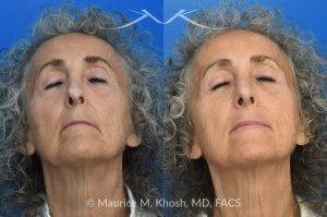 Photo of a patient before and after a procedure. Revision rhinoplasty with lower blepharoplasty 1 - This patient underwent revision rhinoplasty to improve nasal airflow, refine nasal tip symmetry, and achieve a natural, un-operated appearance. An open approach was used to place bilateral spreader grafts—double-layered on the left and single-layered on the right—fashioned from the septum. Ear cartilage was utilized as alar strut grafts to reshape and support the nasal tip, and septo-columellar sutures were used to improve columellar position. A cadaveric dermal graft was applied to the dorsum to create a smooth and natural contour. A lower eyelid blepharoplasty was performed simultaneously for added rejuvenation.
