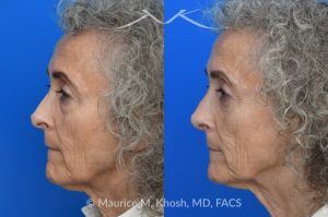 Photo of a patient before and after a procedure. Revision rhinoplasty with lower blepharoplasty 1 - This patient underwent revision rhinoplasty to improve nasal airflow, refine nasal tip symmetry, and achieve a natural, un-operated appearance. An open approach was used to place bilateral spreader grafts—double-layered on the left and single-layered on the right—fashioned from the septum. Ear cartilage was utilized as alar strut grafts to reshape and support the nasal tip, and septo-columellar sutures were used to improve columellar position. A cadaveric dermal graft was applied to the dorsum to create a smooth and natural contour. A lower eyelid blepharoplasty was performed simultaneously for added rejuvenation.