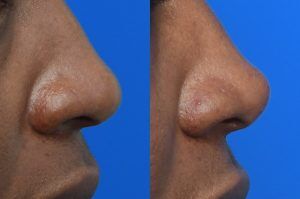 Photo of a patient before and after a procedure. Nasal Tip Enhancement with Dermal Fillers - Filler injections were used to enhance the nasal tip. 

