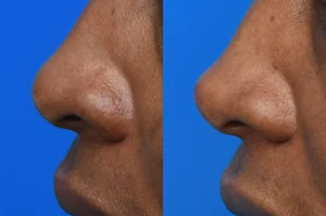 Photo of a patient before and after a procedure. Nasal Tip Enhancement with Dermal Fillers - Filler injections were used to enhance the nasal tip. 


