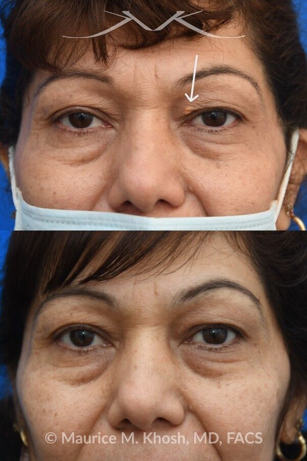 Before-and-after photos showing surgical excision of a small xanthelasma in the left upper eyelid with no visible postoperative scar, frontal view.