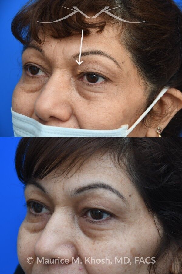 Before-and-after photos showing surgical excision of a small xanthelasma in the left upper eyelid with no visible postoperative scar, left oblique view.