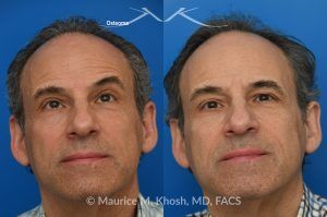 Photo of a patient before and after a procedure. Small Osteoma Removal via Hairline Incision - A relatively small osteoma in this patient was removed through a hairline incision, leaving no visible scar. 
