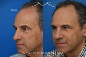 Photo of a patient before and after a procedure. Small Osteoma Removal via Hairline Incision - A relatively small osteoma in this patient was removed through a hairline incision, leaving no visible scar. 
