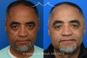 Photo of a patient before and after a procedure. Precision Lipoma Excision on the Right Temple - A medium sized lipoma on the right temple was excised, leaving no recognizable scar. Lipoma excision in the temple region requires exacting precision to avoid injuring the facial nerve branch that elevates the brow. 