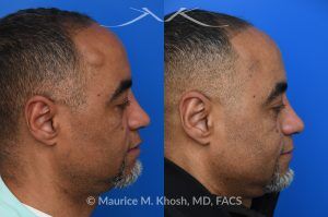 Photo of a patient before and after a procedure. Precision Lipoma Excision on the Right Temple - A medium sized lipoma on the right temple was excised, leaving no recognizable scar. Lipoma excision in the temple region requires exacting precision to avoid injuring the facial nerve branch that elevates the brow. 