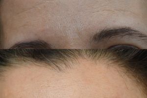 Photo of a patient before and after a procedure. Nevus of Left Forehead - A mole on the mid-left forehead was carefully excised, and the resulting defect was meticulously repaired along the natural horizontal forehead rhytids. This strategic alignment allowed the final scar to blend seamlessly with the surrounding skin, making it nearly imperceptible.
