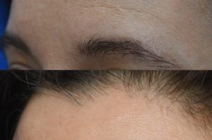 Photo of a patient before and after a procedure. Nevus of Left Forehead - A mole on the mid-left forehead was carefully excised, and the resulting defect was meticulously repaired along the natural horizontal forehead rhytids. This strategic alignment allowed the final scar to blend seamlessly with the surrounding skin, making it nearly imperceptible.
