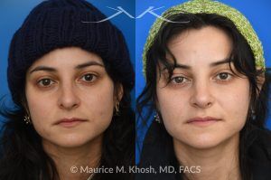 Photo of a patient before and after a procedure. Revision rhinoplasty - This young patient has a history of prior rhinoplasty resulting in a poorly defined, ptotic nasal tip with significant downward rotation on smiling. She also exhibited right-sided alar retraction, contributing to noticeable nostril asymmetry. Revision rhinoplasty was performed using an open approach to address all aesthetic and structural concerns.

A composite graft of skin and cartilage harvested from the ear was used to restore and support the right nostril position. A septal extension graft was placed to elevate and stabilize the ptotic nasal tip. Additionally, suture techniques were utilized to refine and narrow the nasal tip, achieving improved symmetry and definition.