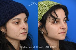 Photo of a patient before and after a procedure. Revision rhinoplasty - This young patient has a history of prior rhinoplasty resulting in a poorly defined, ptotic nasal tip with significant downward rotation on smiling. She also exhibited right-sided alar retraction, contributing to noticeable nostril asymmetry. Revision rhinoplasty was performed using an open approach to address all aesthetic and structural concerns.

A composite graft of skin and cartilage harvested from the ear was used to restore and support the right nostril position. A septal extension graft was placed to elevate and stabilize the ptotic nasal tip. Additionally, suture techniques were utilized to refine and narrow the nasal tip, achieving improved symmetry and definition.