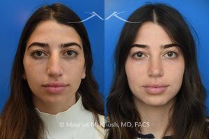 Photo of a patient before and after a procedure. Rhinoplasty to Remove Dorsal Hump and Refine the Tip -  The patient sought to improve her nose's appearance, specifically aiming to reduce a prominent dorsal hump and achieve a more refined nasal tip. We utilized an open rhinoplasty approach, allowing for precise dorsal reduction and lateral osteotomies. We placed bilateral spreader grafts to preserve and support nasal airflow. We refined the tip using dome-binding sutures without removing cartilage, which maintained structural integrity. We carefully controlled the final tip position and projection using septo-columellar sutures, resulting in a balanced and natural contour.