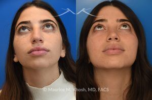 Photo of a patient before and after a procedure. Rhinoplasty to Remove Dorsal Hump and Refine the Tip -  The patient sought to improve her nose's appearance, specifically aiming to reduce a prominent dorsal hump and achieve a more refined nasal tip. We utilized an open rhinoplasty approach, allowing for precise dorsal reduction and lateral osteotomies. We placed bilateral spreader grafts to preserve and support nasal airflow. We refined the tip using dome-binding sutures without removing cartilage, which maintained structural integrity. We carefully controlled the final tip position and projection using septo-columellar sutures, resulting in a balanced and natural contour.