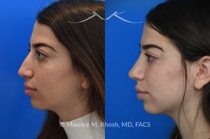 Photo of a patient before and after a procedure. Rhinoplasty to Remove Dorsal Hump and Refine the Tip -  The patient sought to improve her nose's appearance, specifically aiming to reduce a prominent dorsal hump and achieve a more refined nasal tip. We utilized an open rhinoplasty approach, allowing for precise dorsal reduction and lateral osteotomies. We placed bilateral spreader grafts to preserve and support nasal airflow. We refined the tip using dome-binding sutures without removing cartilage, which maintained structural integrity. We carefully controlled the final tip position and projection using septo-columellar sutures, resulting in a balanced and natural contour.