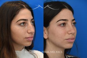 Photo of a patient before and after a procedure. Rhinoplasty to Remove Dorsal Hump and Refine the Tip -  The patient sought to improve her nose's appearance, specifically aiming to reduce a prominent dorsal hump and achieve a more refined nasal tip. We utilized an open rhinoplasty approach, allowing for precise dorsal reduction and lateral osteotomies. We placed bilateral spreader grafts to preserve and support nasal airflow. We refined the tip using dome-binding sutures without removing cartilage, which maintained structural integrity. We carefully controlled the final tip position and projection using septo-columellar sutures, resulting in a balanced and natural contour.