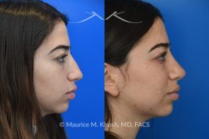 Photo of a patient before and after a procedure. Rhinoplasty to Remove Dorsal Hump and Refine the Tip -  The patient sought to improve her nose's appearance, specifically aiming to reduce a prominent dorsal hump and achieve a more refined nasal tip. We utilized an open rhinoplasty approach, allowing for precise dorsal reduction and lateral osteotomies. We placed bilateral spreader grafts to preserve and support nasal airflow. We refined the tip using dome-binding sutures without removing cartilage, which maintained structural integrity. We carefully controlled the final tip position and projection using septo-columellar sutures, resulting in a balanced and natural contour.