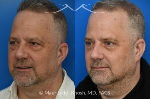 Photo of a patient before and after a procedure. Upper and Lower Blepharoplasty - This patient sought to improve the “tired” appearance of his eyes. He underwent upper blepharoplasty along with a lower blepharoplasty performed through a transconjunctival (inside the eyelid) approach. This combination effectively refreshed his overall look, restoring a more youthful and well-rested appearance while avoiding any visible external scarring on the lower eyelids.  