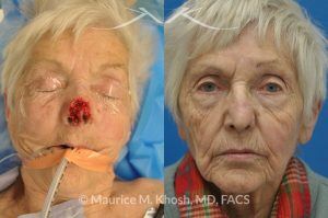 Photo of a patient before and after a procedure. Nose Moh's skin cancer repair, utilizing forehead flap and ear cartilage graft - before and after photos.