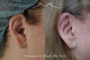 Photo of a patient before and after a procedure. Mohs defect of ear repaired with a post auricular flap -  This patient underwent reconstruction of a surgical defect in the conchal bowl using a transposition flap harvested from the posterior auricular surface. The repaired site is virtually imperceptible, achieving a seamless and natural result.