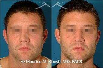 🥇 New York Nose Reconstruction Facial Plastic Surgeon | Manhattan