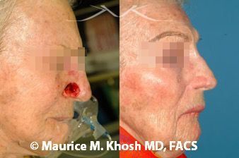 🥇 New York Nose Reconstruction Facial Plastic Surgeon | Manhattan