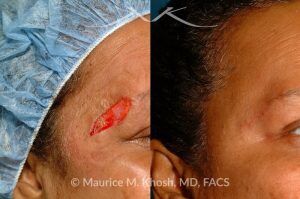 Photo of a patient before and after a procedure. Repair of brow defect - before and after results.