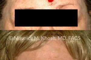 Photo of a patient before and after a procedure. Repair of mid forehead defect - before and after results.
