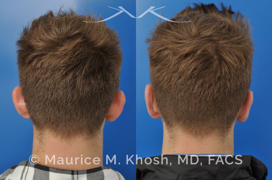 Ear pinning to push back excessively projected ears and flatten ears