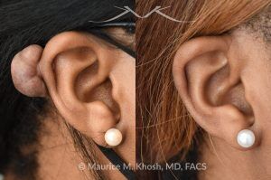 Photo of a patient before and after a procedure. Keloid of the Ear - before and after treatment results.