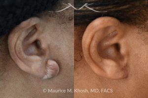 Photo of a patient before and after a procedure.  Dense Keloid of Right Earlobe - before and after treatment results.