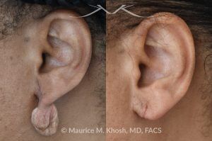 Photo of a patient before and after a procedure.  Dense Keloid of Right Earlobe - before and after treatment results.