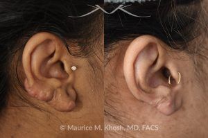 Photo of a patient before and after a procedure. Large Dumble Shaped Keloid of Right Ear - before and after treatment results.