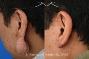 Photo of a patient before and after a procedure. Large Hanging Keloid of Earlobe - before and after treatment results.