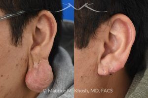 Photo of a patient before and after a procedure. Large Hanging Keloid of Earlobe - before and after treatment results.