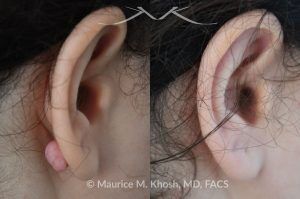 Photo of a patient before and after a procedure. Keloid Scar on Back of Right Earlobe - before and after treatment results.
