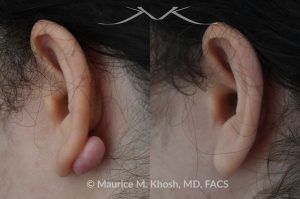 Photo of a patient before and after a procedure. Keloid Scar on Back of Right Earlobe - before and after treatment results.